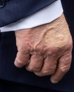 Trump Diagnosed with Chronic Venous Insufficiency: What This Means 