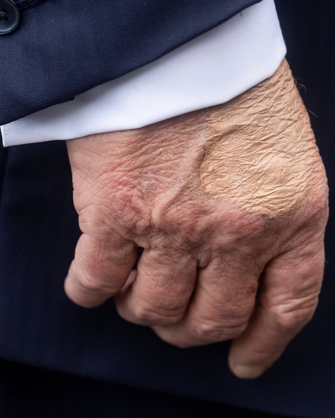 Trump Diagnosed with Chronic Venous Insufficiency: What This Means 